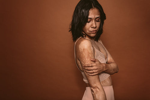 Living with vitiligo