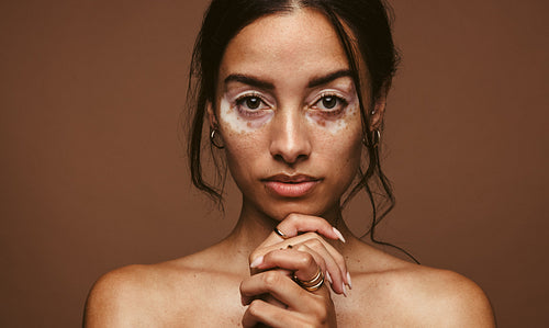 Portrait of woman with vitiligo