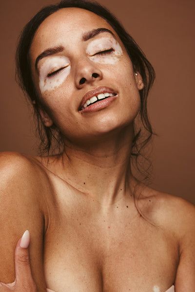 Confident woman with vitiligo