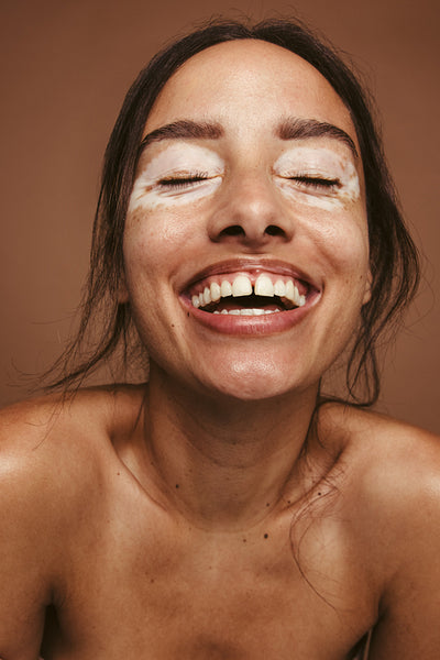 Woman embracing her vitiligo