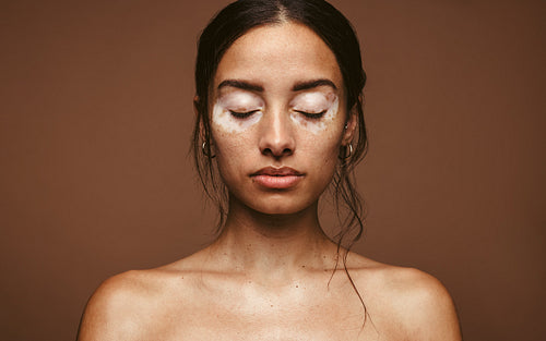 Embrace your skin condition