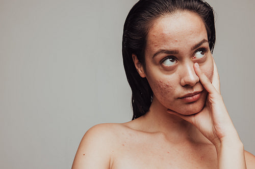 Woman frustrated about skin problems