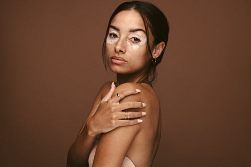My vitiligo is beautiful