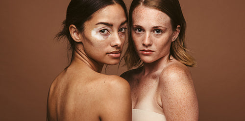 Confident woman with unique skin