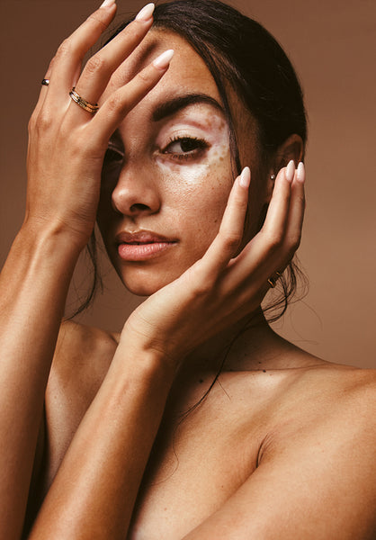 Portrait of woman with vitiligo