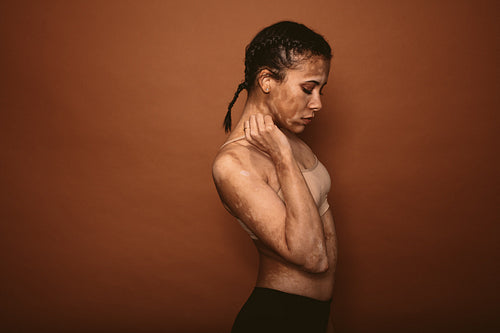 Skinny woman affected with vitiligo
