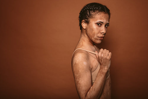 Young woman with vitiligo disease