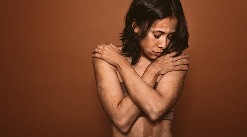 Young woman affected with vitiligo