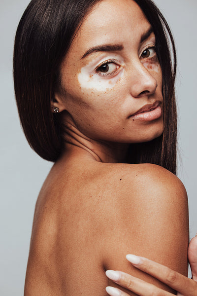 Portrait Of Woman With Vitiligo Stock Photo (237958), 41% OFF